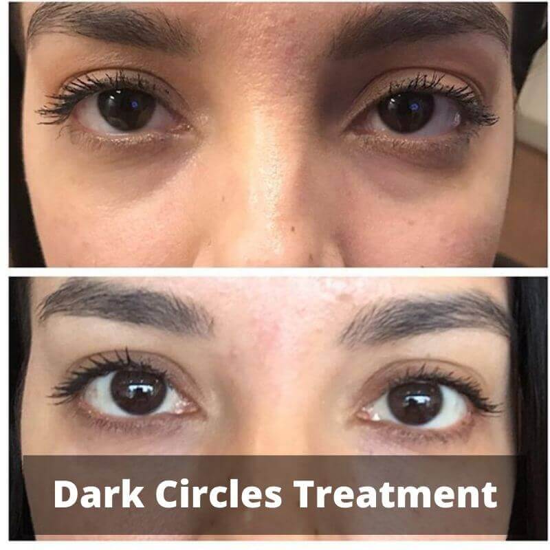 dark-circle-treatment-prp-treatment-center