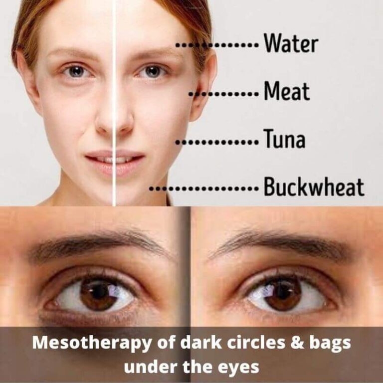 Mesotherapy of dark circles & bags under the eyes PRP Treatment center