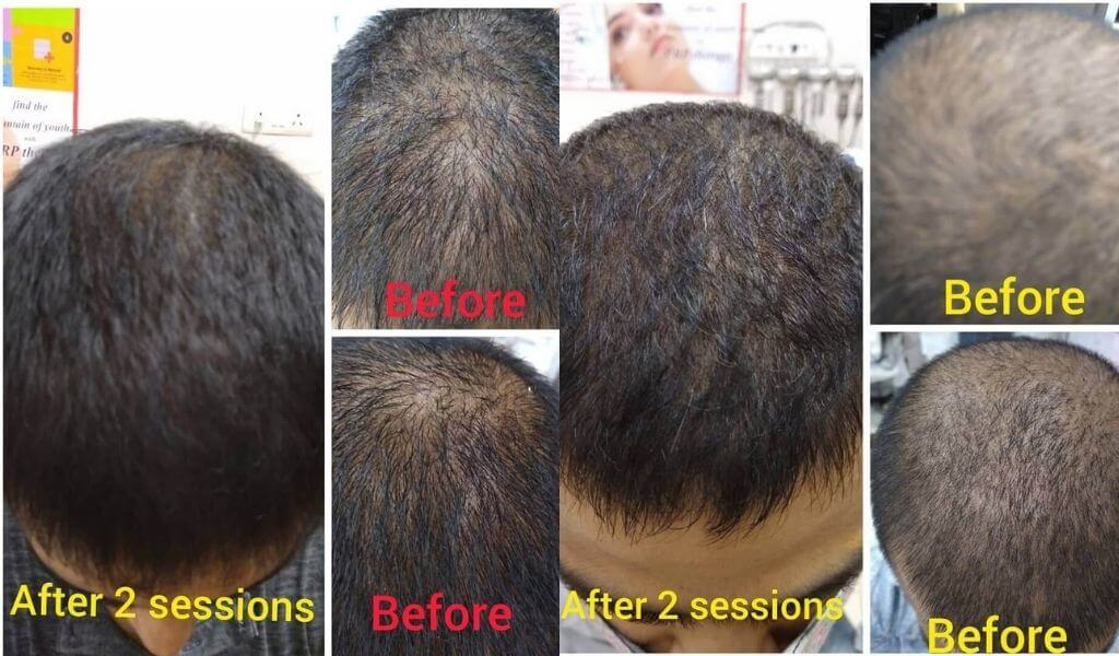 Hair Loss Treatment in Delhi  Best Hair Fall Treatment Clinic in South  Delhi India