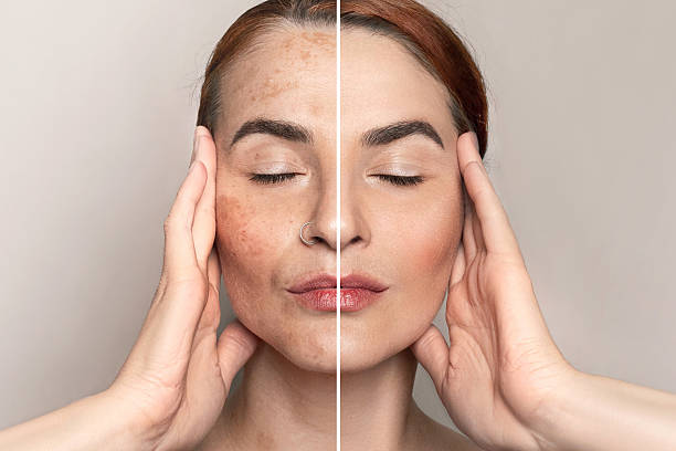 Pigmentation & Melasma Treatment Karol Bagh