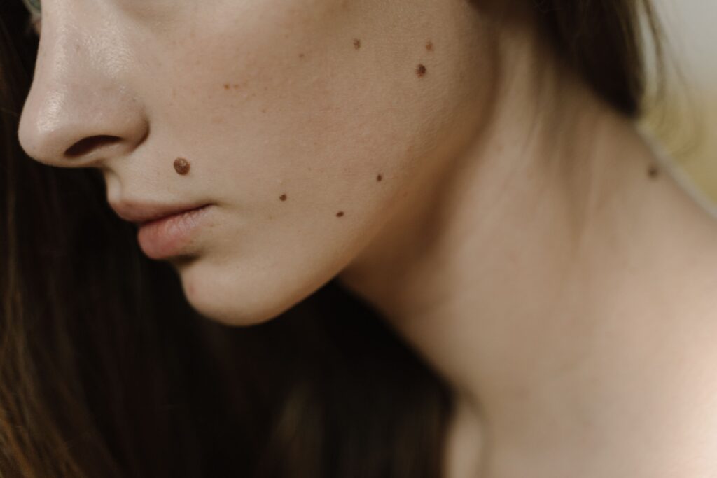 Warts & Skin Tag Removal