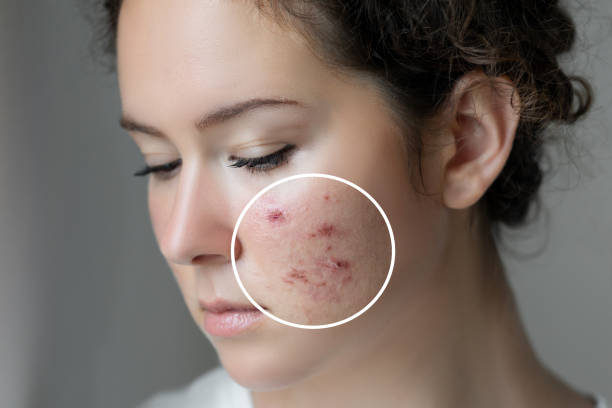 Acne & Pimples Treatment in Delhi