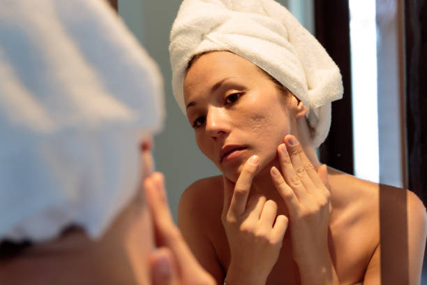 Acne Scar Treatment in Delhi